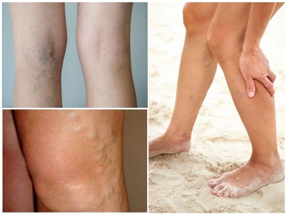 Síntomas de las venas varicosas
