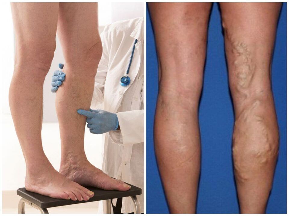 varices