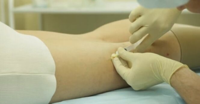 Tratamiento de las venas varicosas en mujeres