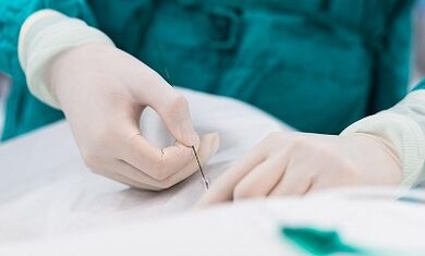 Diagnóstico de venas varicosas de una pelvis pequeña