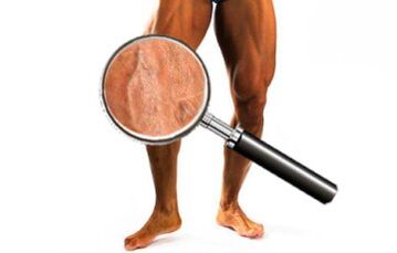 Girar las venas para las venas varicosas
