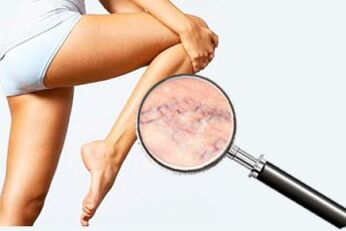 Varicosis de las piernas