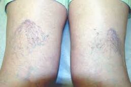 Arañas vasculares en las piernas en la primera etapa de las venas varicosas.