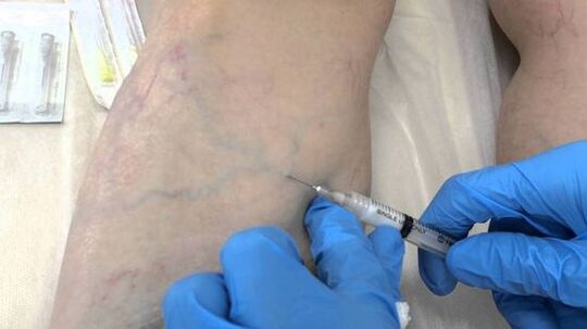 escleroterapia para las venas varicosas en las piernas en mujeres