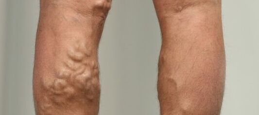 venas varicosas en la pierna