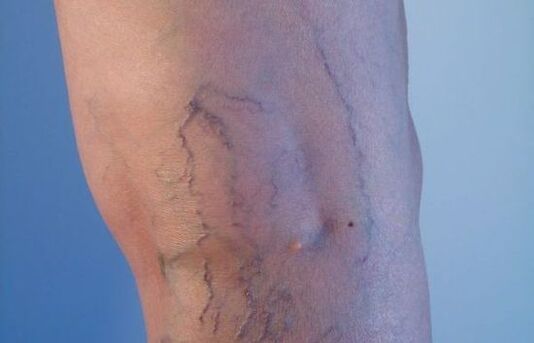 venas varicosas en las piernas en mujeres