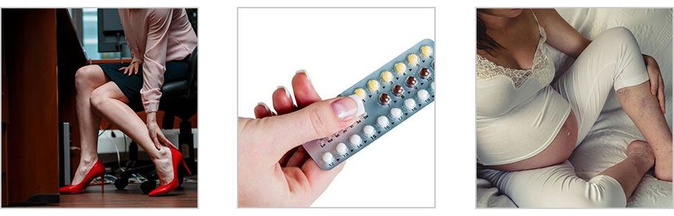 causas de las venas varicosas en las piernas