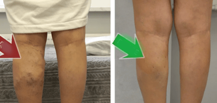 resultados del tratamiento de las venas varicosas en las piernas