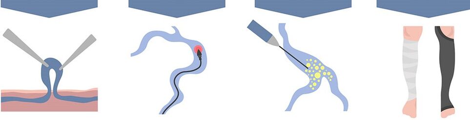 tipos de tratamiento para las venas varicosas