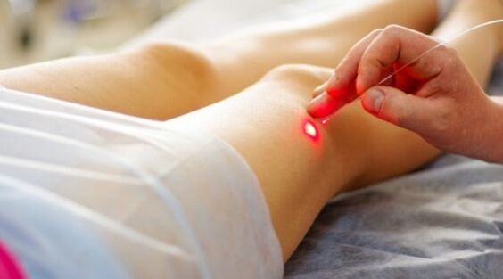 Coagulación con láser para varices de las extremidades inferiores.