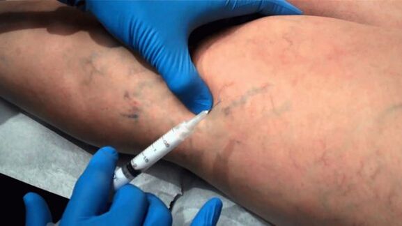 Escleroterapia para venas varicosas