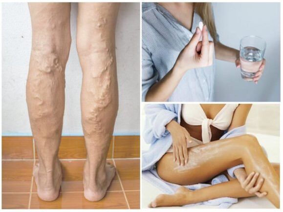 Métodos de tratamiento para las venas varicosas en las piernas.