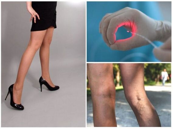 Tratamiento con láser de varices en las piernas.
