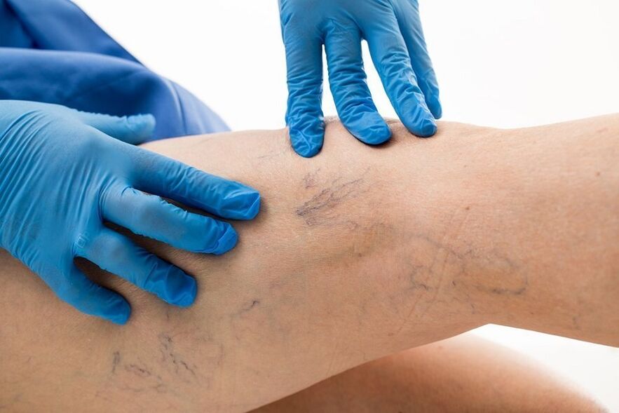 examen de las piernas para detectar venas varicosas