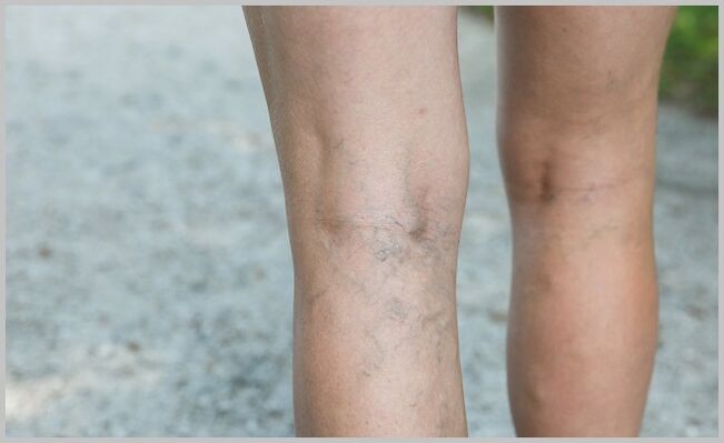 venas protuberantes de las piernas con venas varicosas