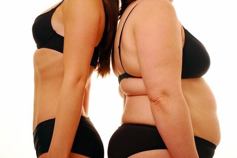 Cuerpo delgado y obesidad como causa de venas varicosas.