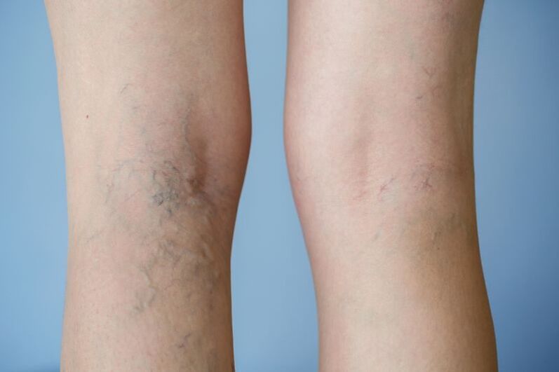foto de venas varicosas en las piernas
