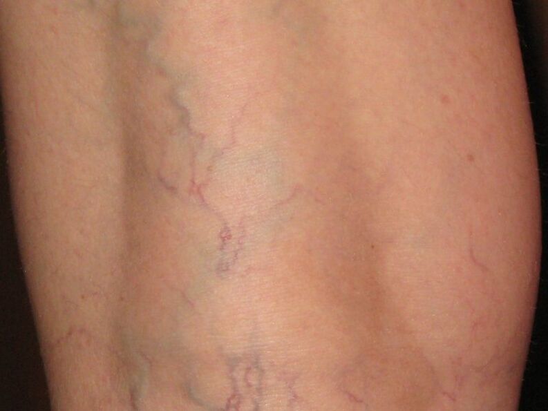signos de venas varicosas en las piernas