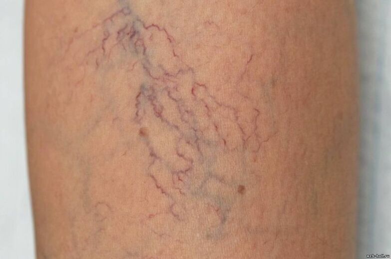 síntomas de venas varicosas en las piernas