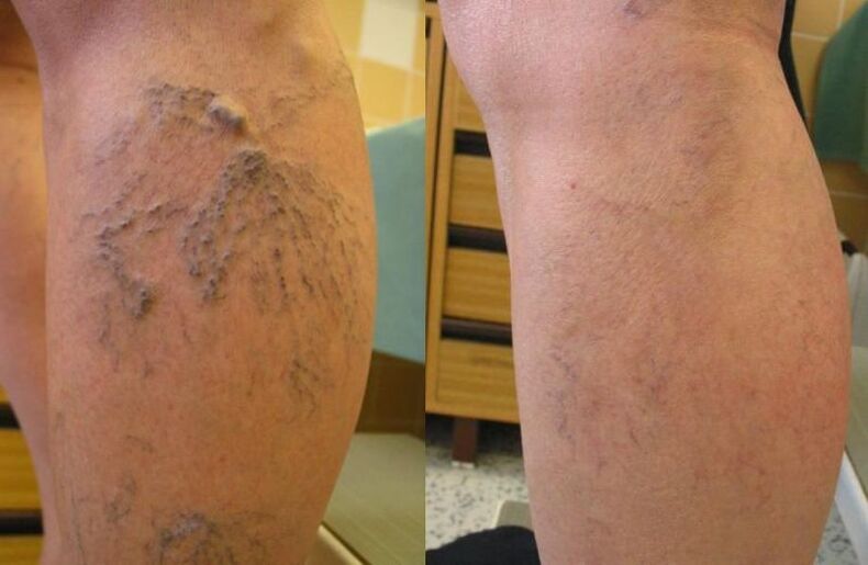 varices iniciales y avanzadas