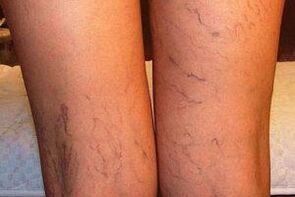 foto de venas varicosas en las piernas