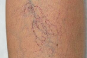 varices
